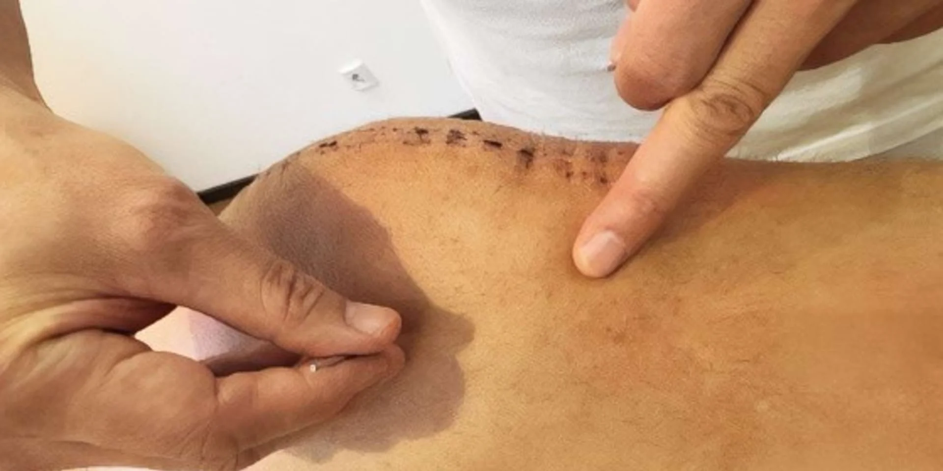 Akupunktur Behandlung eines Knies mit Pi-Nadel in der Johannesbad Fachklinik Raupennest Akupunktur Behandlung eines Knies mit Pi-Nadel in der Johannesbad Fachklinik Raupennest