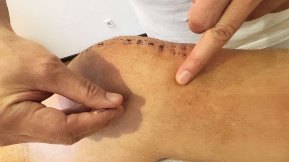 Akupunktur Behandlung eines Knies mit Pi-Nadel in der Johannesbad Fachklinik Raupennest Akupunktur Behandlung eines Knies mit Pi-Nadel in der Johannesbad Fachklinik Raupennest